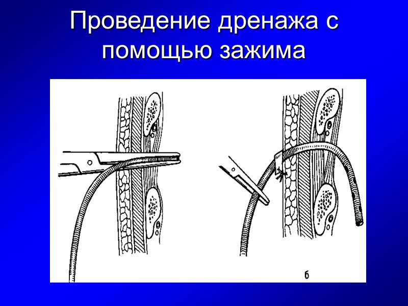 Проведение дренажа с помощью зажима